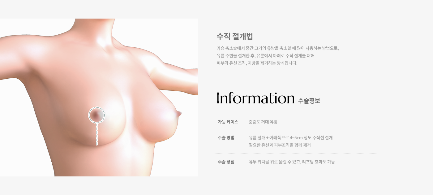 가슴축소