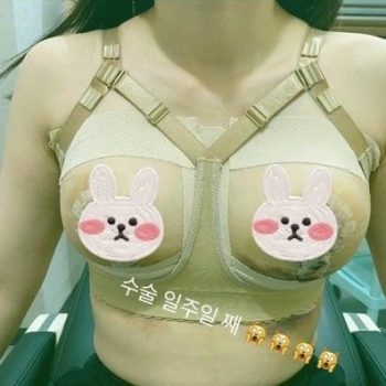 가슴축소+리프팅