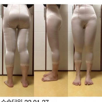 허벅지지방흡입 후기