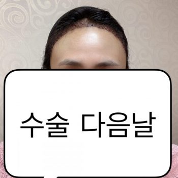 헤어라인모발이식 후기