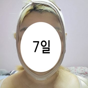 얼굴지방흡입 후기