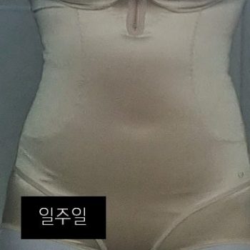 복부지방흡입 후기