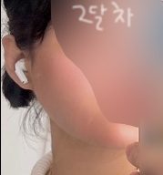 얼굴지방흡입 후기